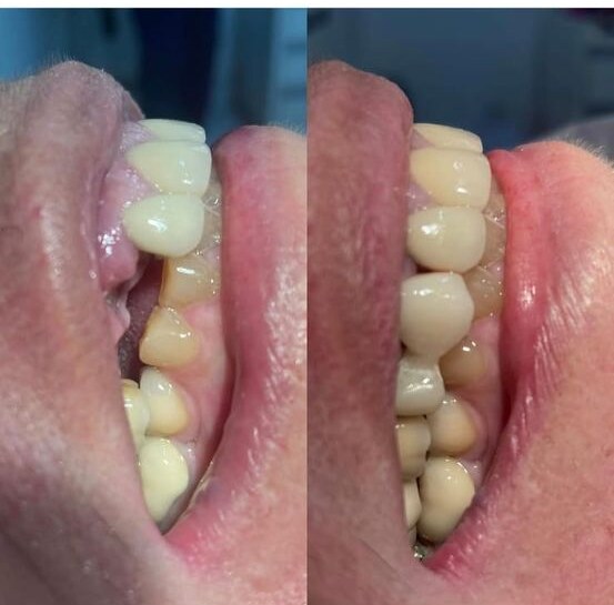 Caso clínico de prótese sobre implante realizado na Oral Clinic, comparativo de antes e depois